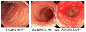 福州胃肠医博在线咨询结肠炎怎么检查