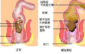 预防便秘的方法有哪些